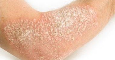 La psoriasis cerca de las fotos recién nacidas